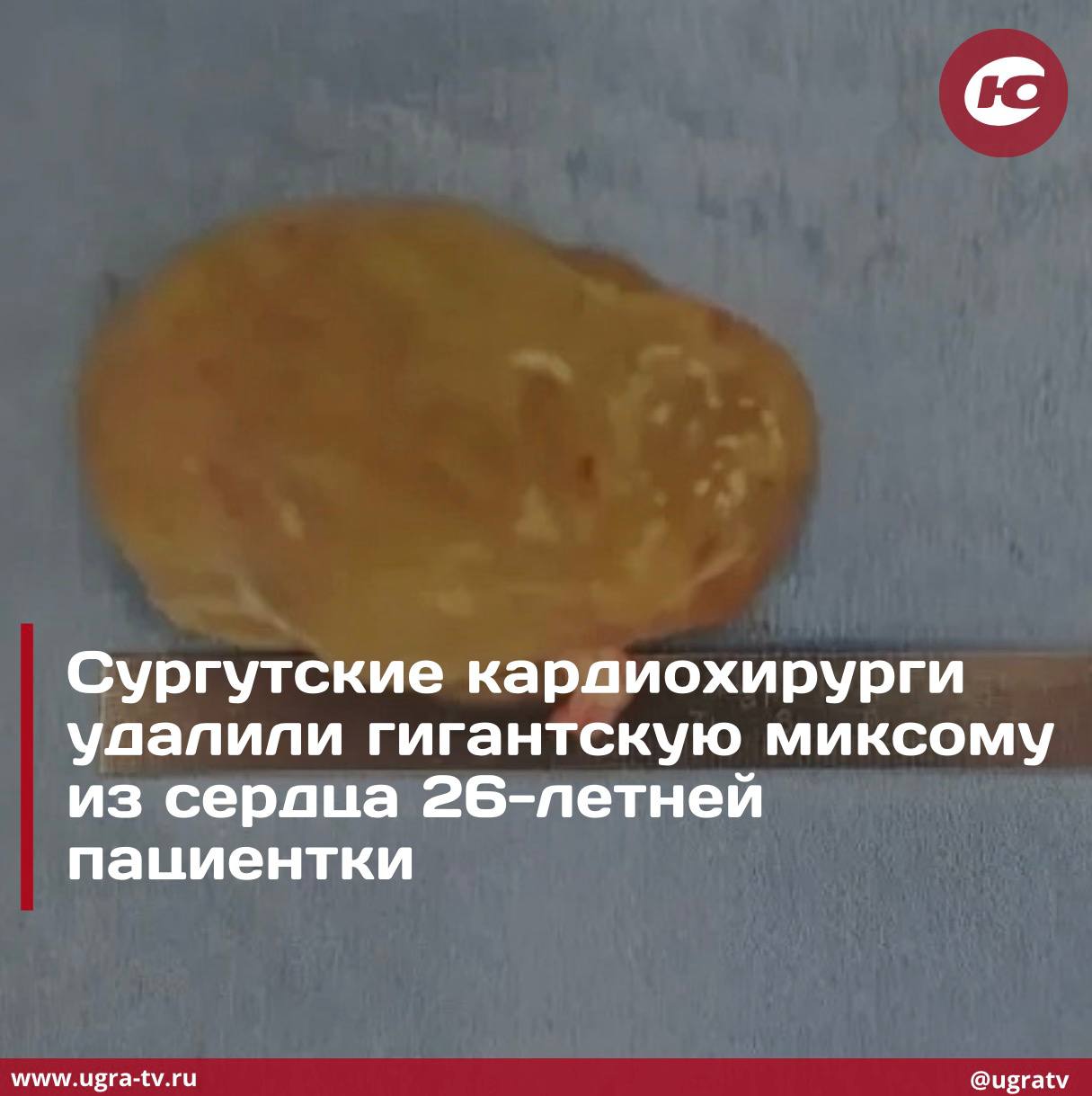 Удалили гигантскую миксому