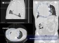 В Сургуте врачи спасли женщину от опухоли таза 30 см, проросшей в грудную клетку