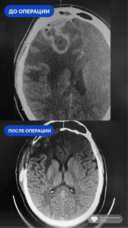 Насморк довел жителя Сургута до отека мозга и трепанации черепа Насморк довел жителя Сургута до отека мозга и трепанации черепа